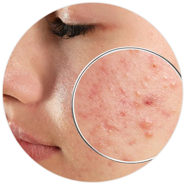 Ashwagandha and Kashmiri saffron skincare for acne and pimples