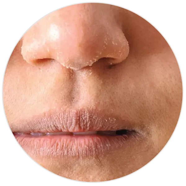 Dry skin skincare
